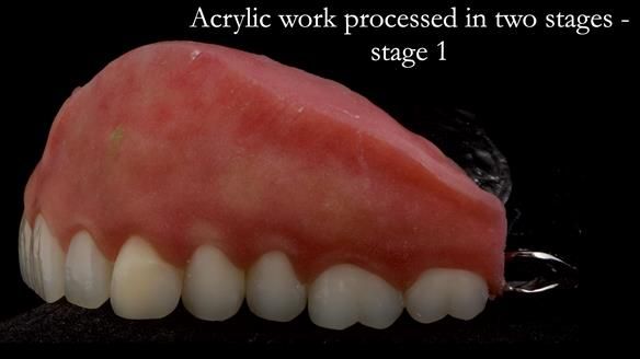 Upper metal base partial denture/occlusal stabilisation splint/obturator - full protocol