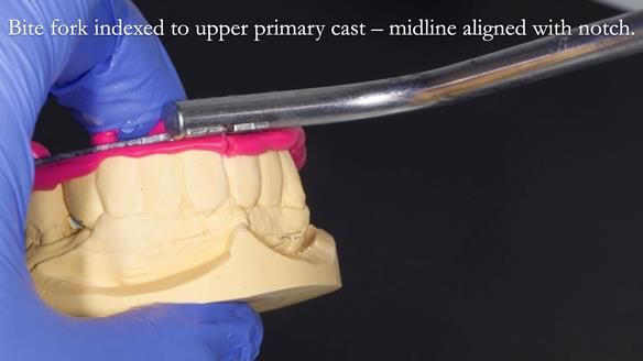 Newsletter 77: Jeremy’s case – immediate complete upper denture