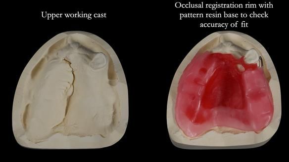 Newsletter 55 Provision of metal based partial dentures for Zephyrine with a repaired cleft lip and palate