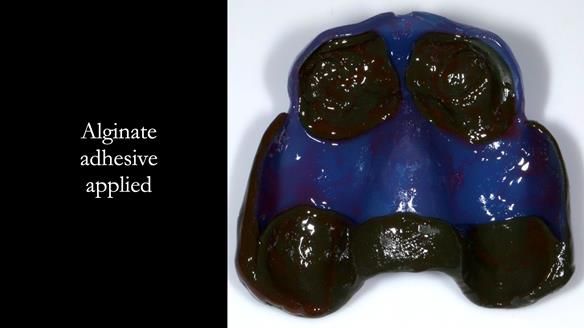 Newsletter 77: Jeremy’s case – immediate complete upper denture