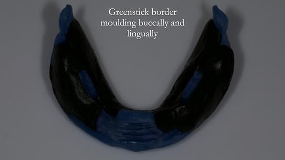 Newsletter 83: Sheila’s Complete Denture Success