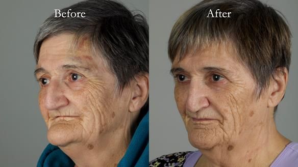 Newsletter 83: Sheila’s Complete Denture Success