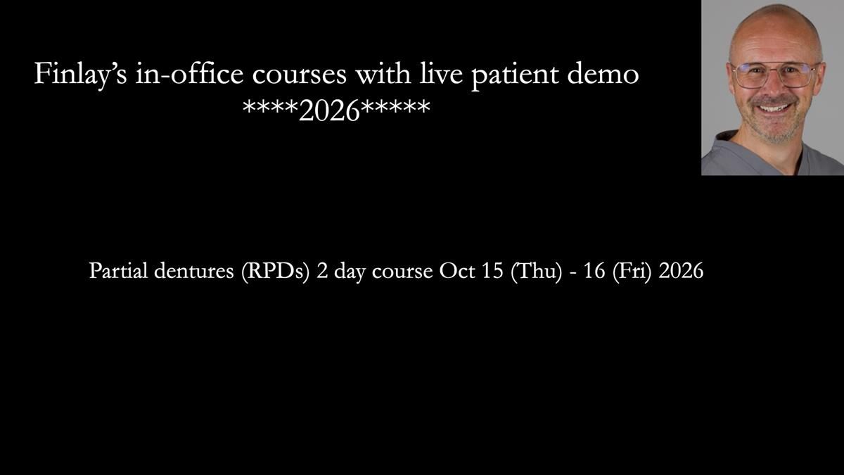 Newsletter 89 – Simon: A Challenging Kennedy Class II Division 1 Upper CoCr Partial Denture with a High Smile Line