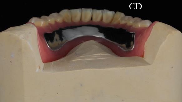 Finlay's Newsletter 62 provision of extractions and metal based complete dentures for Rafique