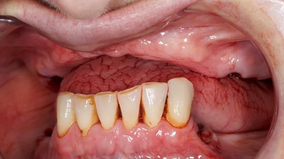 Newsletter 52 Managing Jo’s failing dentition with extractions and Mk 1/Mk 2 complete upper dentures and lower partial dentures FULL PROTOCOL