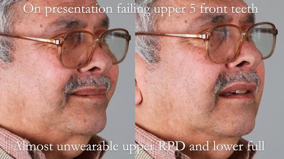 Finlay's Newsletter 62 provision of extractions and metal based complete dentures for Rafique