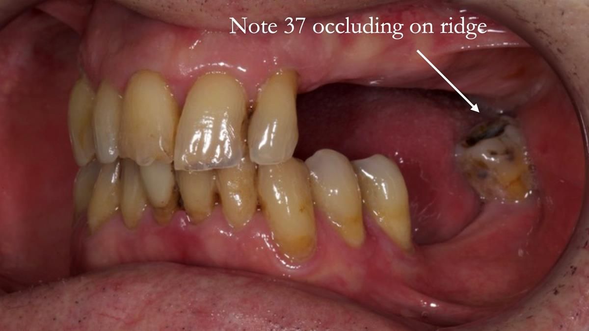 Newsletter 89 – Simon: A Challenging Kennedy Class II Division 1 Upper CoCr Partial Denture with a High Smile Line