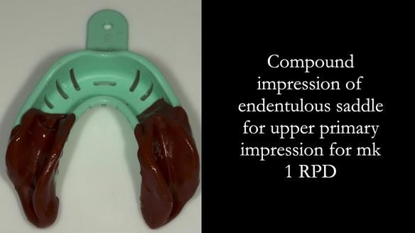 Finlay's Case Study Newsletter 40 - Immediate Mk 1 RPD to Definitive Mk 2 RPD - full protocol