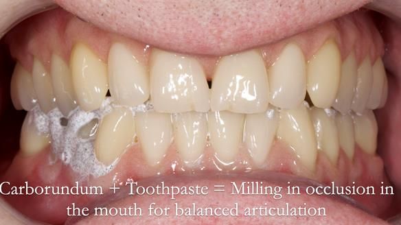 Newsletter 57 showcases the making and fitting process of implant-supported complete dentures for Alisdair