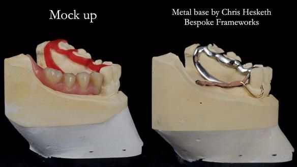 Finlay's Newsletter 61 provision of a lower unilateral free end saddle metal based partial denture for Joyce