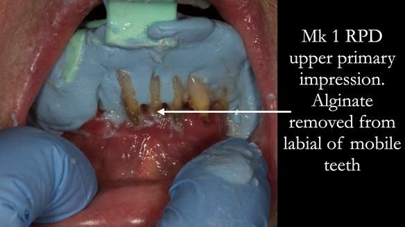 Finlay's Case Study Newsletter 40 - Immediate Mk 1 RPD to Definitive Mk 2 RPD - full protocol