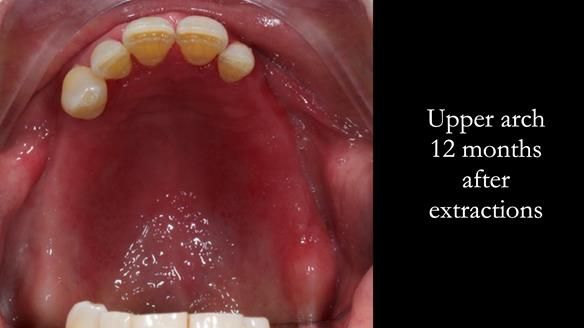 Finlay's Case Study Newsletter 40 - Immediate Mk 1 RPD to Definitive Mk 2 RPD - full protocol