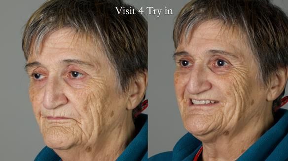 Newsletter 83: Sheila’s Complete Denture Success