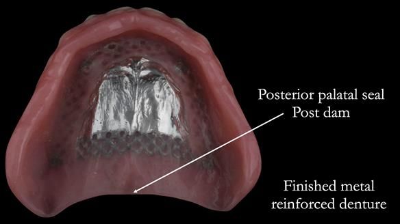 Finished metal reinforced upper denture finished to the land area of the model for optimal polished surfaces