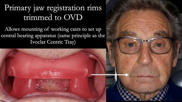 Newsletter 50 Special edition Complete Dentures FULL PROTOCOL