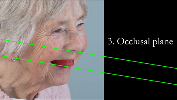 Figure 71 From the side view the occlusal plane is carved parallel with the ala-tragal line (Camper’s plane) as this is approximately parallel with the occlusal plane in fully dentate people