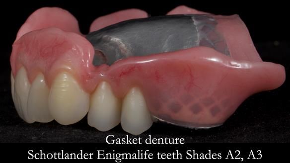 Finlay's Newsletter 58 Gasket upper partial denture for Zoe