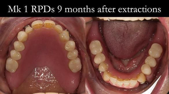 Finlay's Case Study Newsletter 40 - Immediate Mk 1 RPD to Definitive Mk 2 RPD - full protocol