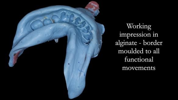 Newsletter 52 Managing Jo’s failing dentition with extractions and Mk 1/Mk 2 complete upper dentures and lower partial dentures FULL PROTOCOL