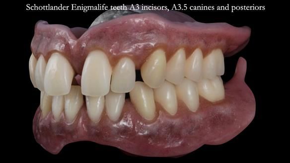 Newsletter 53 showing the making and fitting of ultra life-like dentures for Valena