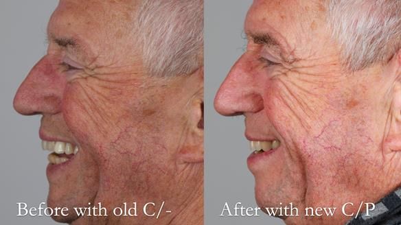 Newsletter 54 case presentation upper complete denture and lower Scandinavian designed hygienic partial denture for David