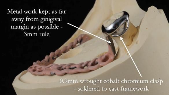 Finlay's Newsletter 59 Ultra hard partial dentures made for Gill