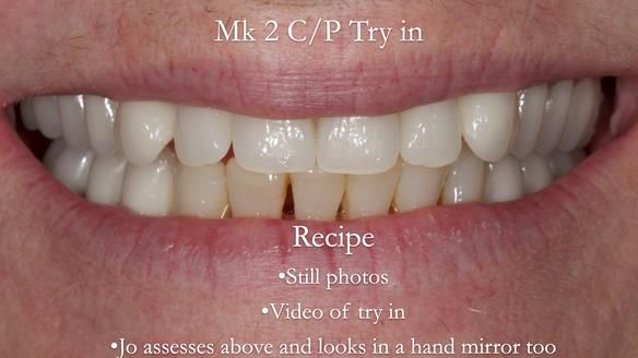 Newsletter 52 Managing Jo’s failing dentition with extractions and Mk 1/Mk 2 complete upper dentures and lower partial dentures FULL PROTOCOL