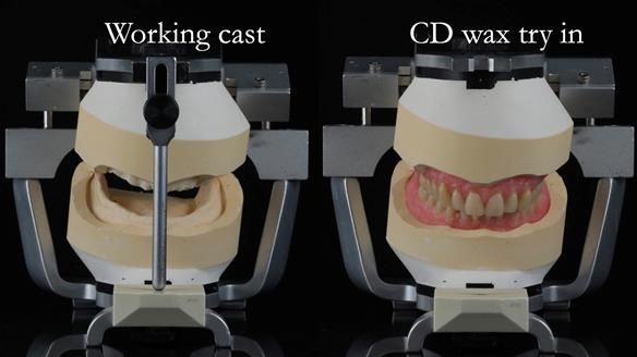 Finlay's Newsletter 62 provision of extractions and metal based complete dentures for Rafique