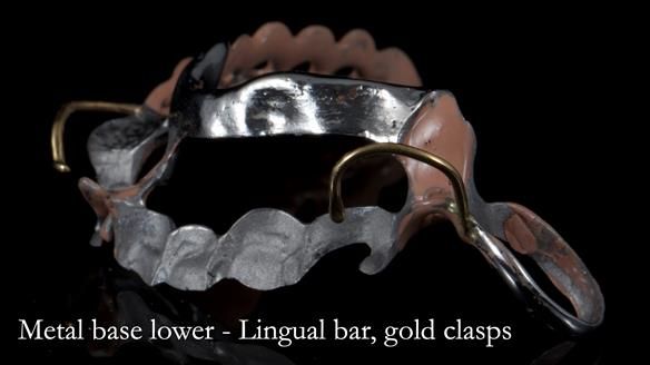 Newsletter 55 Provision of metal based partial dentures for Zephyrine with a repaired cleft lip and palate
