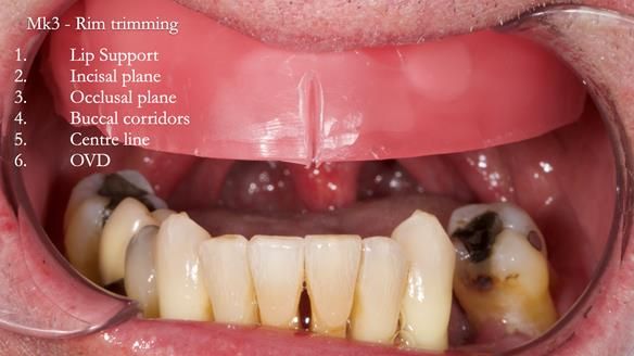 Newsletter 77: Jeremy’s case – immediate complete upper denture