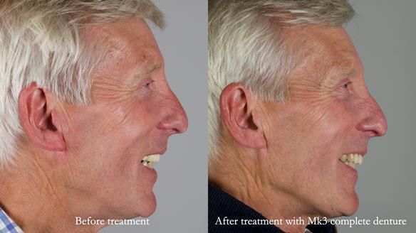 Newsletter 77: Jeremy’s case – immediate complete upper denture