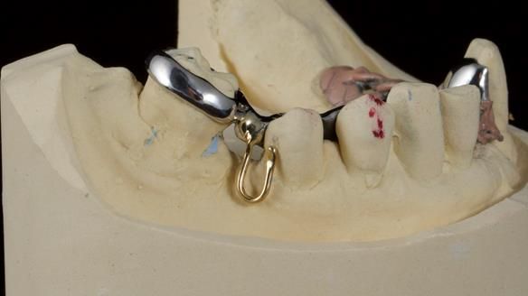 Newsletter 86 Peter the Architect — precision removable partial dentures case study
