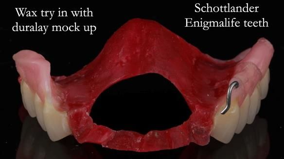Finlay's Newsletter 60 Sylvia's upper Kennedy Class 2 Mod 1 metal based upper RPD