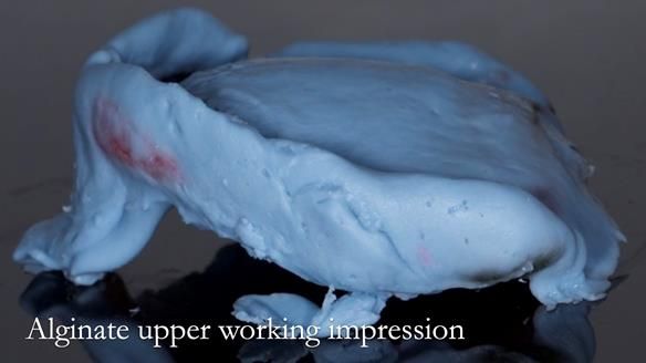 Managing poor implant positioning with complete dentures and Locator attachments - full protocol Newsletter 41