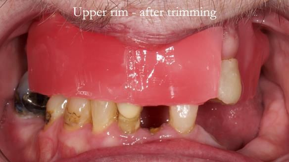 Newsletter 55 Provision of metal based partial dentures for Zephyrine with a repaired cleft lip and palate