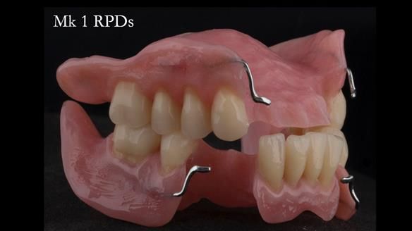 Finlay's Case Study Newsletter 40 - Immediate Mk 1 RPD to Definitive Mk 2 RPD - full protocol