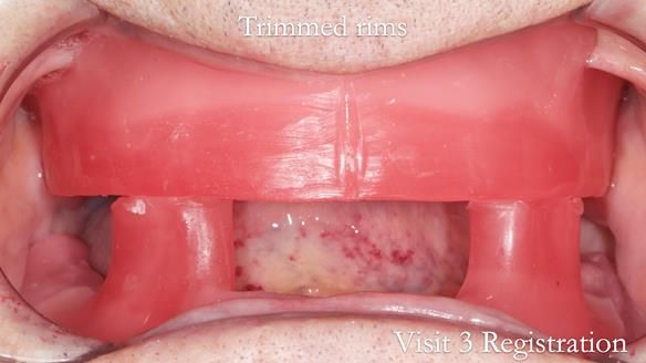 Newsletter 50 Special edition Complete Dentures FULL PROTOCOL