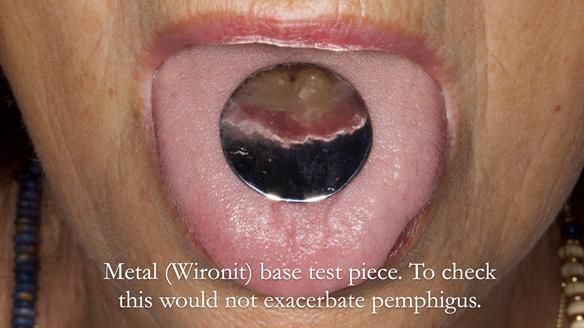 Newsletter 56 showing the making and fitting of a bilateral free end saddle upper removable partial denture (RPD) for patient with pemphigus