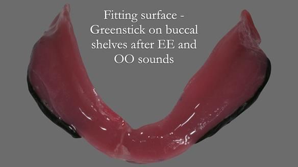 Finlay's Newsletter 62 provision of extractions and metal based complete dentures for Rafique