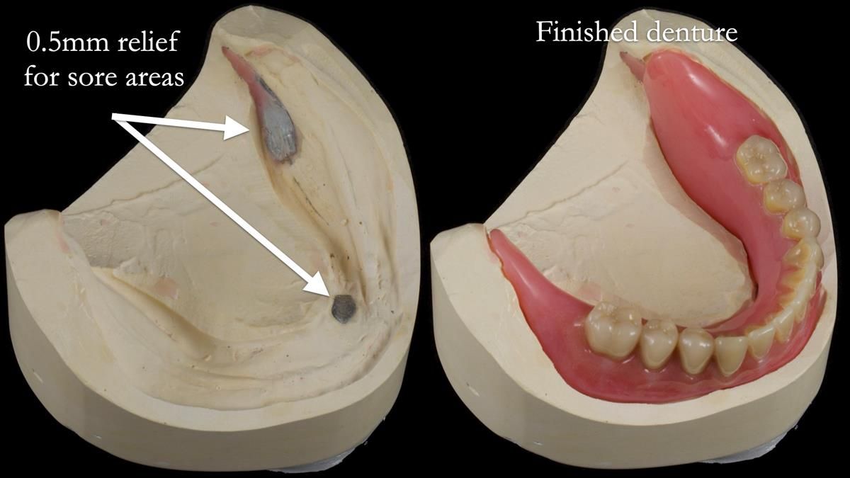 Fin’s Newsletter 88 — Complete dentures - full protocol… he rearranged his own teeth!