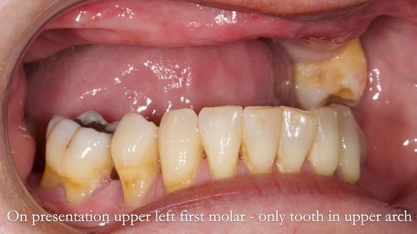 Finlay's Newsletter 58 Gasket upper partial denture for Zoe