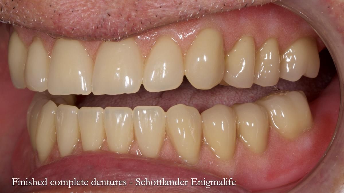 Fin’s Newsletter 88 — Complete dentures - full protocol… he rearranged his own teeth!