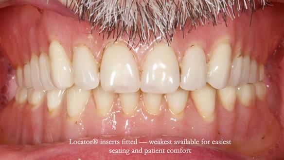 Newsletter 78: What do Clark Gable and a Locator® overdenture have in common?