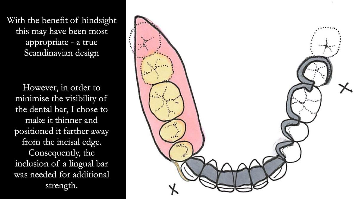 Finlay's Newsletter 61 provision of a lower unilateral free end saddle metal based partial denture for Joyce