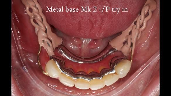 Newsletter 52 Managing Jo’s failing dentition with extractions and Mk 1/Mk 2 complete upper dentures and lower partial dentures FULL PROTOCOL