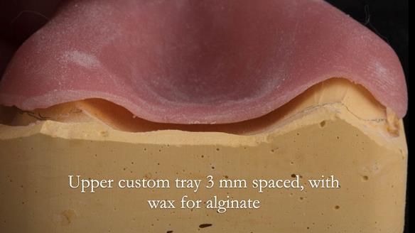 Complete denture Class II div 2 deep overbite Newsletter 39