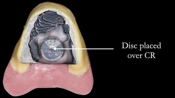 Replacing Madeline’s Complete denture FULL PROTOCOL