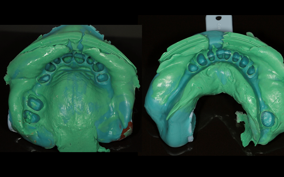 Figure 45 Doric - silicone impressions for the crowns.