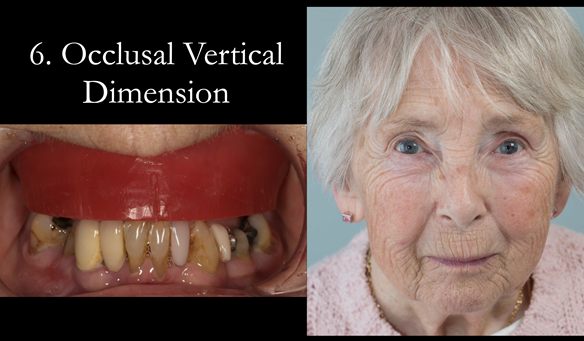 Figure 73 The occluding vertical dimension is prescribed. "If the patient looks right - they are right"