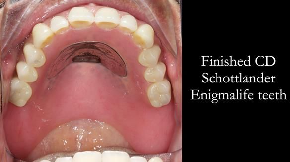 Finlay's Newsletter 62 provision of extractions and metal based complete dentures for Rafique